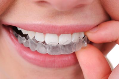 Invisalign Invisible Braces TreatmentMany people have the embarrassing issue of crooked or crowded t